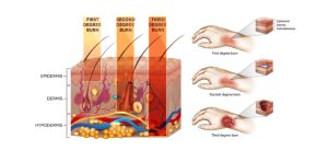 Online basic first aid course – fourth part (burn)